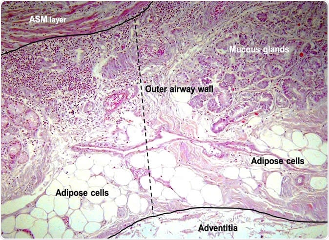 Micrographs (x200) of the (A.) outer airway wall, between the airway smooth muscle (ASM) layer and the airway adventitia (dashed line) showing adipose tissue and mucous glands and (B.) inner airway wall (submucosa), between the basement membrane and ASM layer (dashed line) in a case of fatal asthma stained with haematoxylin and eosin. Inflammatory cells were counted within the inner airway wall. Image Credit: European Respiratory Journal