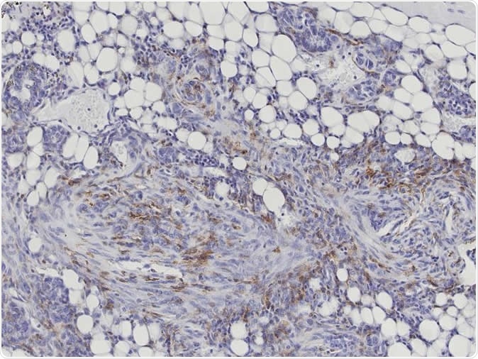 Macrophages (brown), the scavengers of the immune system, migrate into the diseased tissue (cancer cells: blue) without destroying it. Image Credit: Karin E. de Visser/the Netherlands Cancer Institute