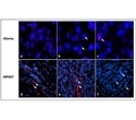 Researchers uncover novel molecular clues for tumor aggression in neurofibromatosis type 1