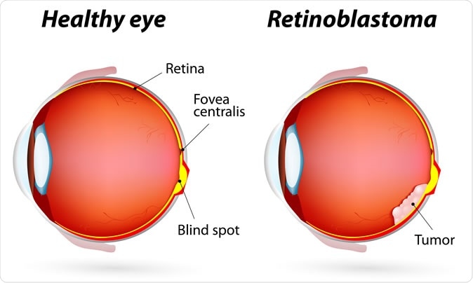 Healthy eye and Retinoblastoma.  Image Credit: Designua / Shutterstock