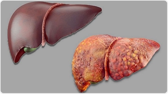 Natural language processing helps evaluate electronic messages from ESLD patients