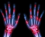 Can Antibiotics Increase the Risk of Arthritis?