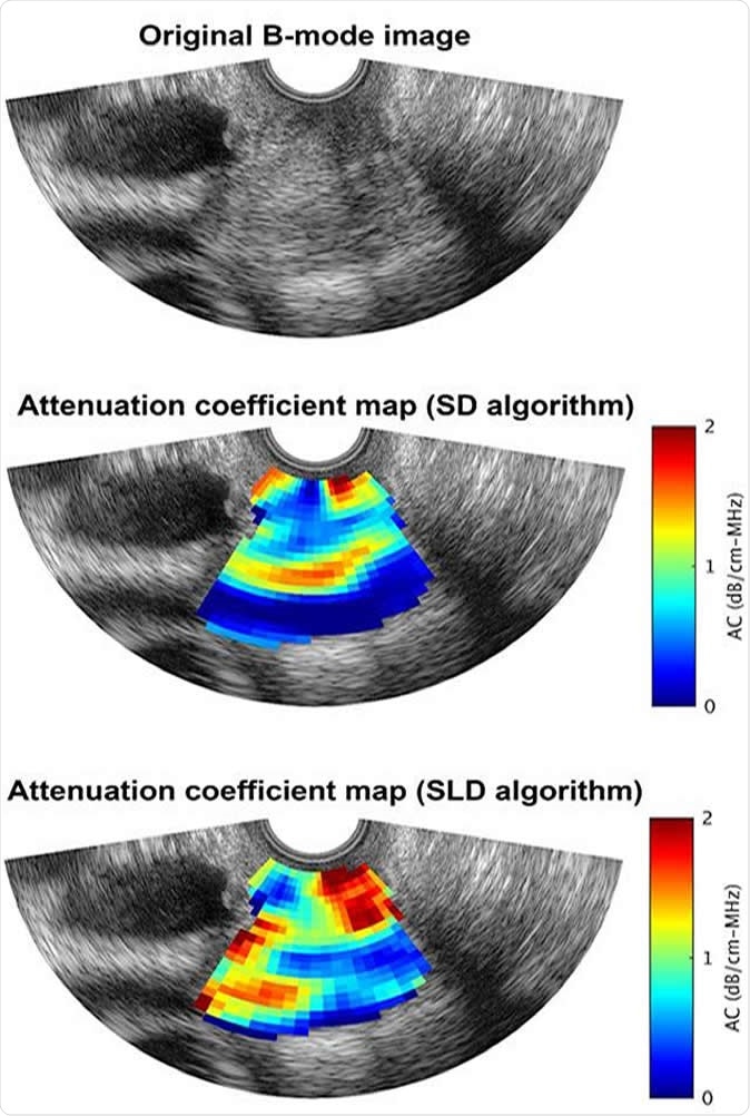 An ultrasound B-mode image of the human cervix superimposed with a) anatomy labels, b) an attenuation coefficient map obtained using the spectral difference (SD) algorithm, and c) an attenuation coefficient map obtained using the spectral log difference (SLD) algorithm. Image Credit: Aiguo Han