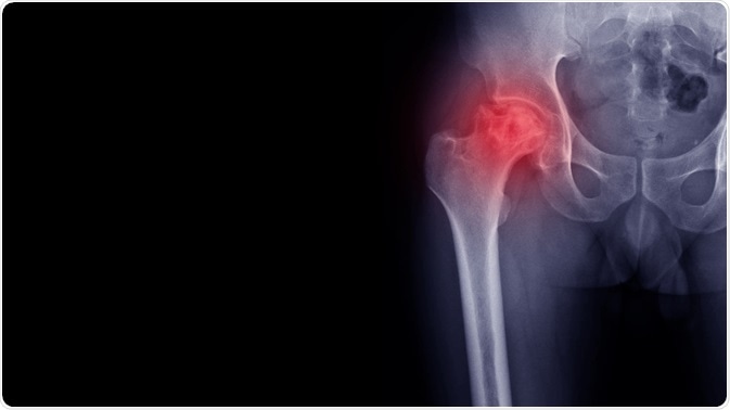 osteoarthritis