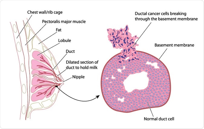 Cross section of female breast with detail of breast cancer - Image Credit: Blamb / Shutterstock
