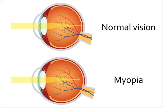 Myopia. Image Credit: Neokryuger / Shutterstock
