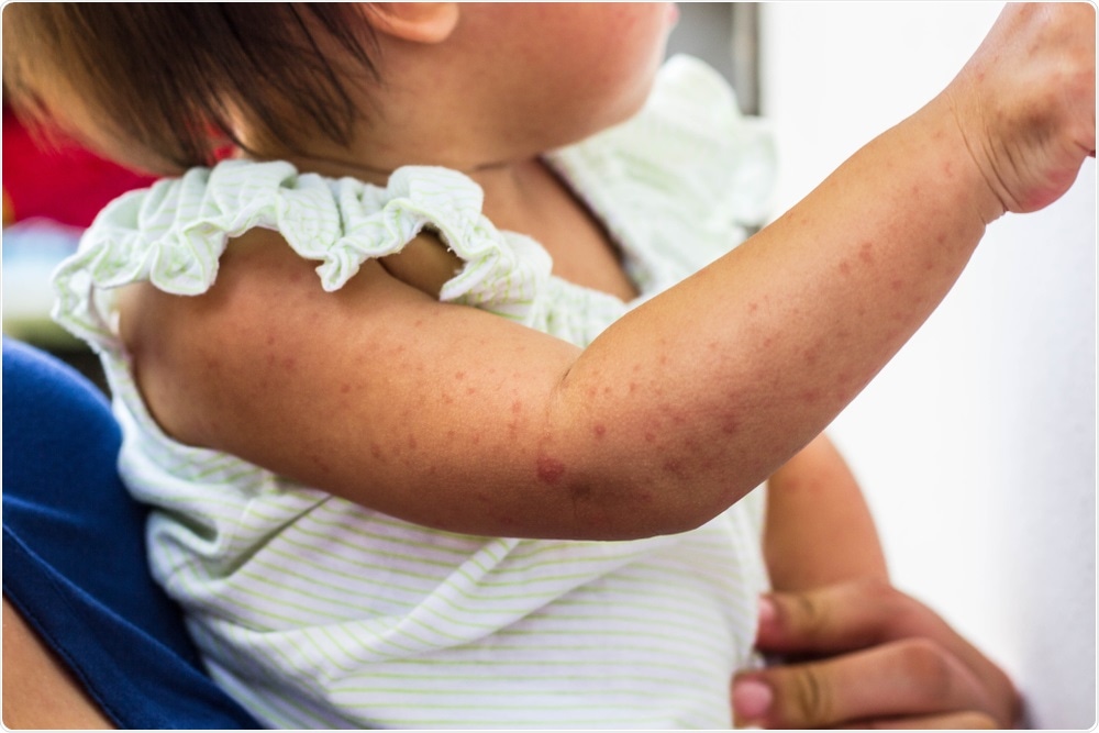 Child with measles