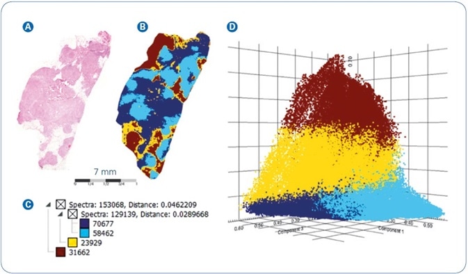 MALDI-MSI analysis of FFPE human breast cancer tissue: (A) Co-registered H&E image of tissue section stained post-MALDI; (B) Spatial segmentation map; (C) Corresponding segmentation tree; (D) PLSA Scores plot from the four main segmentation regions.