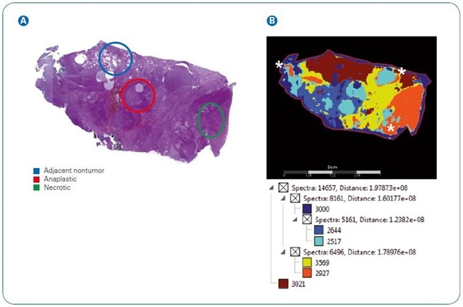 Image segmentation showing complexity of N-glycan signatures in a thyroid cancer tissue section. A Pathologist marked H&E stain of section highlighting adjacent nontumor, anaplastic, and necrotic regions. B SCiLS image segmentation of N-glycans from 2D mapping. White asterisks mark calculated overlaps of anaplastic and necrotic regions.