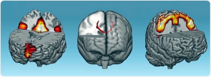 Neural networks that showed increases connectivity after one hour of neurofeedback: default-mode network (left), corpus callosum (middle) and sensorimotor networks (right). Image Credit: D