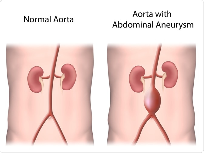 Normal abdominal aorta versus AAA