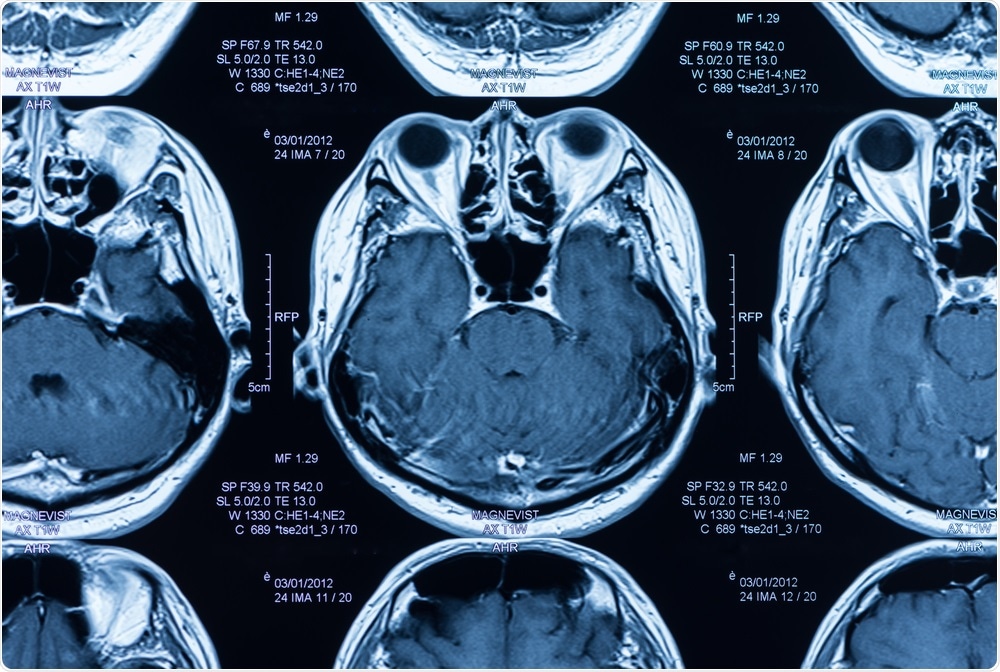 The research team analyzed magnetic resonance imaging (MRI) scans