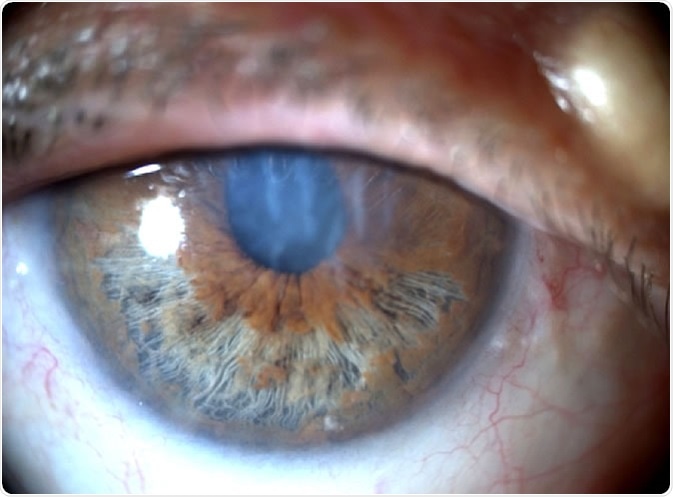 Anterior segment photograph of iridoschisis. Image Credit: EyeWiki