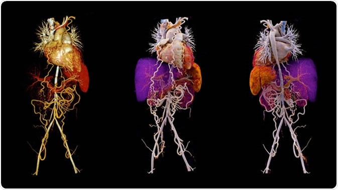 Takayasu Arteritis Treated by Aortic Stenting. Image Credit: Siemens Healthcare GmbH