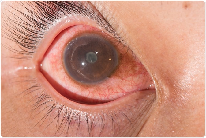 Close up of the anterior uveitis with posterior synechia during eye examination. Image Credit: ARZTSAMUI / Shutterstock