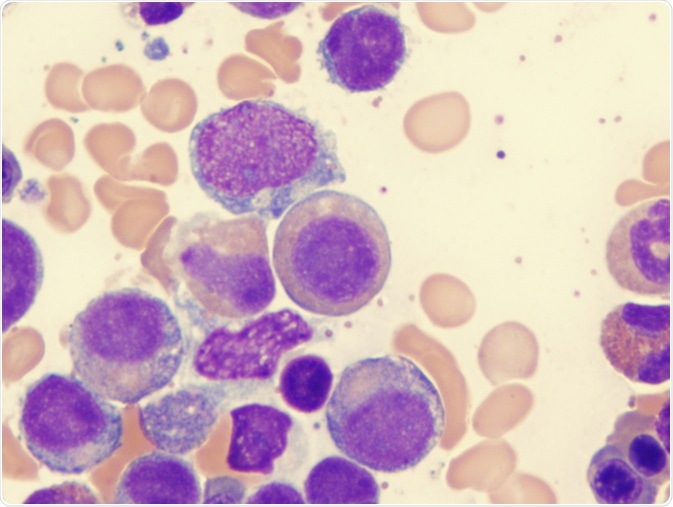 Myelodysplastic sydrome (showing copper ring) - Image Credit: LindseyRN / Shutterstock