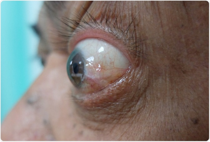 Exopthalmos or prorotosis described as protrusion of the eyeball. Image Credit: Casa Nayafana / Shutterstock