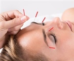 Is Acupuncture Safe?