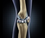 Study uses artificial intelligence to classify patient pain archetypes after knee replacement