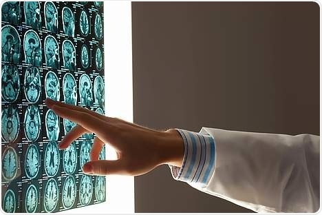 Promising new approaches in the fight against brain metastasis