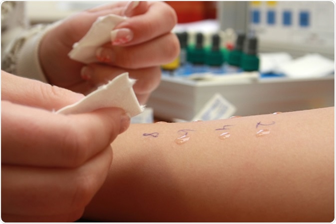Skin prick test. Image Credit: kiep / Shutterstock