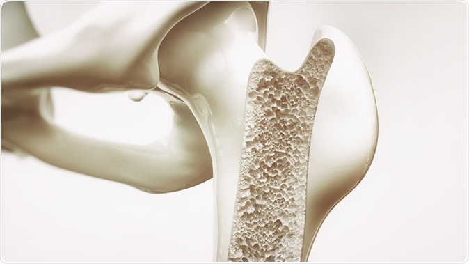 Osteoporosis stage 3 of 4 - upper limb bones - 3d rendering - Illustration Credit: Crevis / Shutterstock