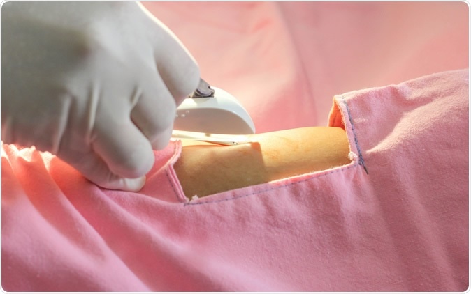 Contraceptive implant. Image Credit: Akkalak Aiempradit / Shutterstock