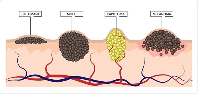The difference between a birthmark, mole, papilloma and melanoma.  Illustration Credit: LiliiaKyrylenko / Shutterstock
