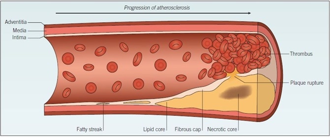 Atherosclerosis. The development of atherosclerosis within a blood vessel wall starts as a fatty streak, composed of a small cluster of lipid-laden macrophages, which progresses over time to form a lipid pool within the vessel wall. Cell debris from apoptotic foam cells within the lipid pool forms a necrotic core. The fibrous cap separates the lipid pool from the blood, but rupture of this cap exposes the thrombogenic plaque contents to circulating blood, triggering thrombus formation.