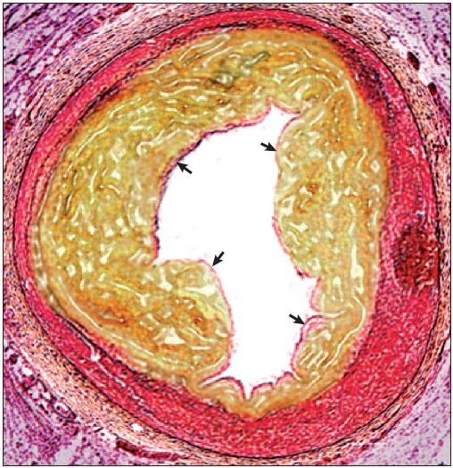 Section through a coronary artery with an atherosclerotic plaque. Lipid accumulation and inflammatory cell invasion (depicted in yellow) within an arterial wall (pink) causes vessel narrowing and stenosis. A thin fibrous cap (arrows) separates the plaque contents from the circulating blood. Rupture of the fibrous cap exposes these thrombogenic contents to the blood, triggering thrombosis.