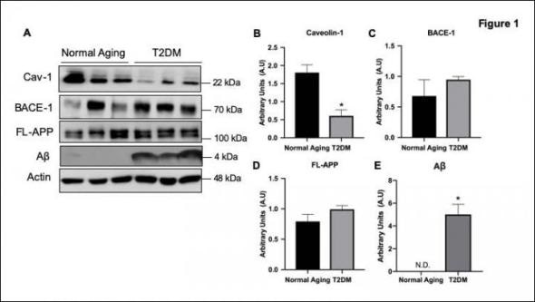 Researchers identify potential target for diabetes-associated Alzheimer