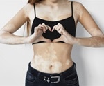 New measurement tool to help treat vitiligo