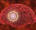 NIH trial aims to improve drug discovery for ischemic stroke