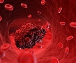 Blood clots speed up aneurysm growth and increase rupture risk, warn researchers