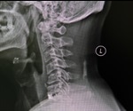 Treatment for Cervical Spondylosis