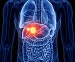 Immune system contribution to tumor heterogeneity may influence liver cancer growth