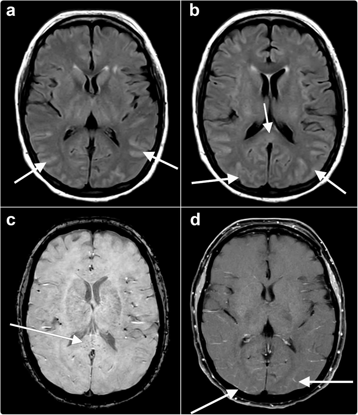 Axial fluid-attenuated inversion recovery (FLAIR) (a, b) images at the level of the basal ganglia show abnormal FLAIR hyperintense signal (arrows) affecting the bilateral occipital, temporal lobes. This appears almost sulcal suggesting a higher protein component within the cerebrospinal fluid. Note the elevated FLAIR signal in the splenium of the corpus callosum (arrow) suggesting parenchymal insult. Axial susceptibility weighted imaging (SWI) (c) at the level of the splenium of the corpus callosum shows small areas of susceptibility (arrow) in the splenium, likely related to microhemorrhage. Axial T1 (d) postcontrast with fat suppression at the level of the basal ganglia shows subtle, though true, enhancement (arrows) in the posterior sulci, arachnoid pial (leptomeningeal) pattern suggesting a degree of encephalitis.
