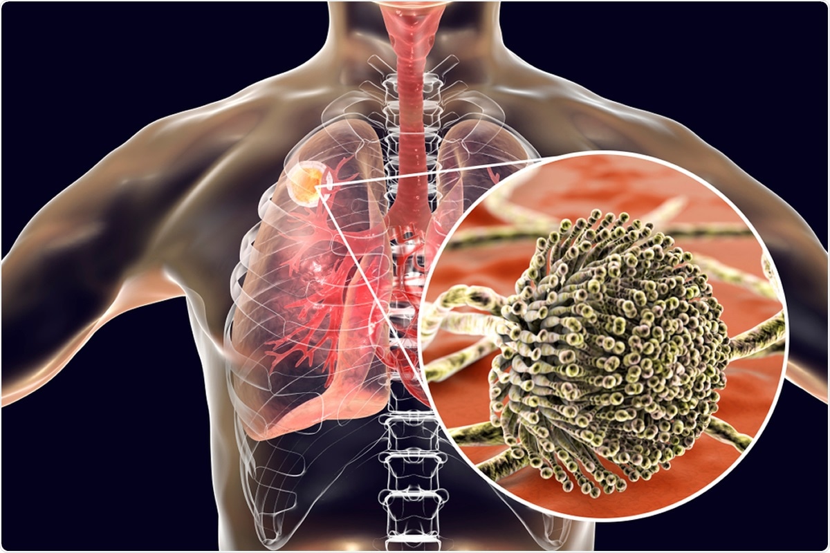 Study: Genomic and phenotypic analysis of COVID-19-associated pulmonary aspergillosis isolates of Aspergillus fumigatus. Image Credit Kateryna Kon / Shutterstock