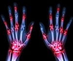 Rheumatoid arthritis may increase risk of dying from COVID-19