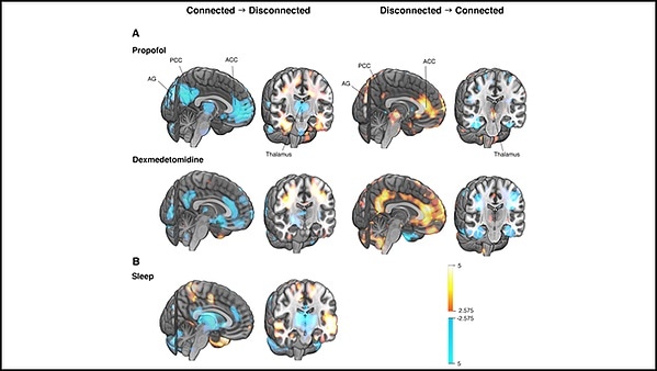 Changes in consciousness linked to the same brain network for sleep and anesthesia Changes in consciousness linked to the same brain network for sleep and anesthesia
