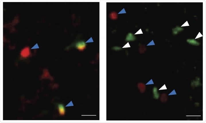 Staining for immune cells shows that the number of ILC2 cells (white arrows) are increased in the choroid plexus of old mice (right) compared with young mice (left). Other types of immune cells are indicated by blue arrows. Image Credit: Fung et al., 20200
