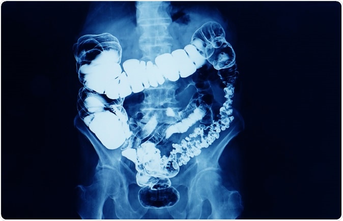Barium enema x-ray showing contrast fill in most part of the large intestines such as transverse colon, sigmoid colon, and rectum. the patient has colon cancer. Image Credit: Yok_onepiece / Shutterstock