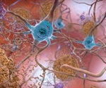 Several key findings from clinical trial of an investigational Alzheimer's disease treatment