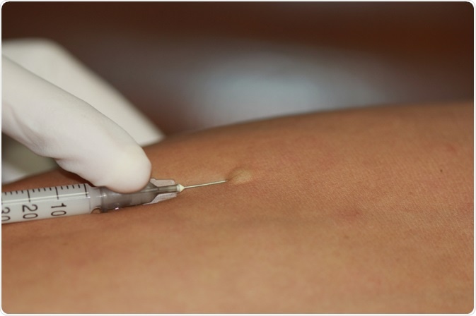 Penicillin Skin Testing Penicillin Skin Testing