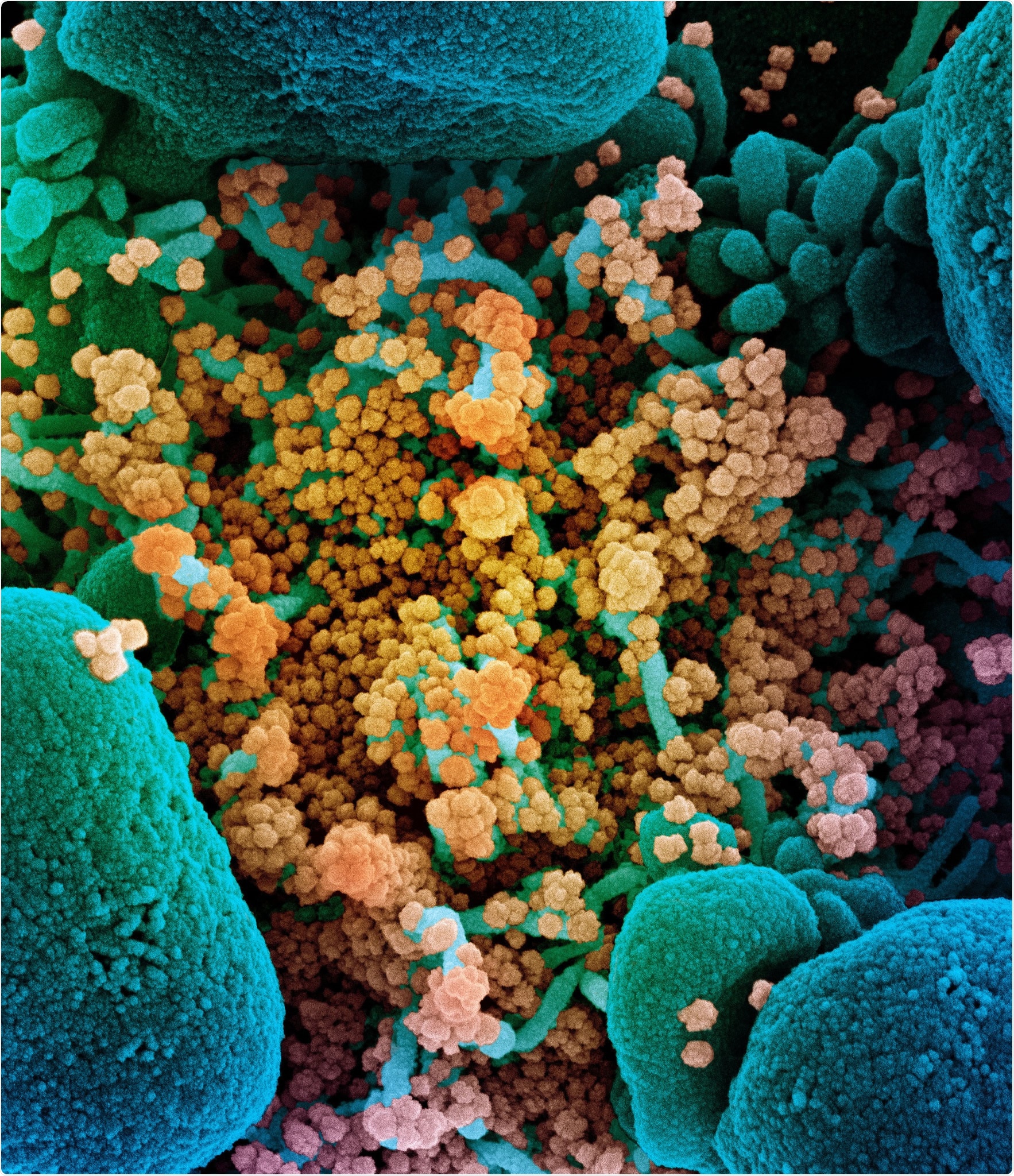 Novel Coronavirus SARS-CoV-2 Colorized scanning electron micrograph of an apoptotic cell (blue) heavily infected with SARS-COV-2 virus particles (yellow), isolated from a patient sample. Image captured at the NIAID Integrated Research Facility (IRF) in Fort Detrick, Maryland. Credit: NIAID