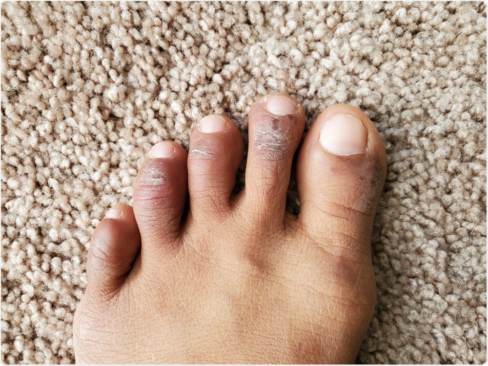 Chilblains on the toes. Image Credit: Ms.Giggles / Shutterstock