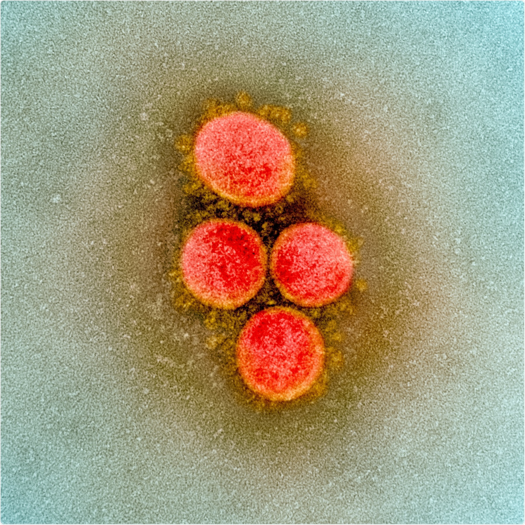 Novel Coronavirus SARS-CoV-2 Transmission electron micrograph of SARS-CoV-2 virus particles, isolated from a patient. Image captured and color-enhanced at the NIAID Integrated Research Facility (IRF) in Fort Detrick, Maryland. Credit: NIAID