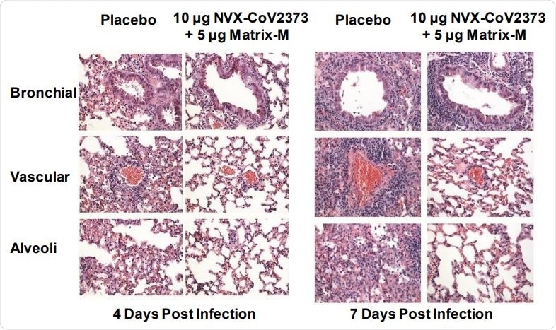 Representative histopathology of lungs from NVX-CoV2373 vaccinated 773 and Ad/CMV/hACE2 transduced mice challenged with SARS-CoV-2.