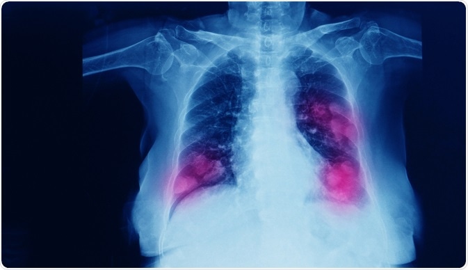 Primary Lung Cancer