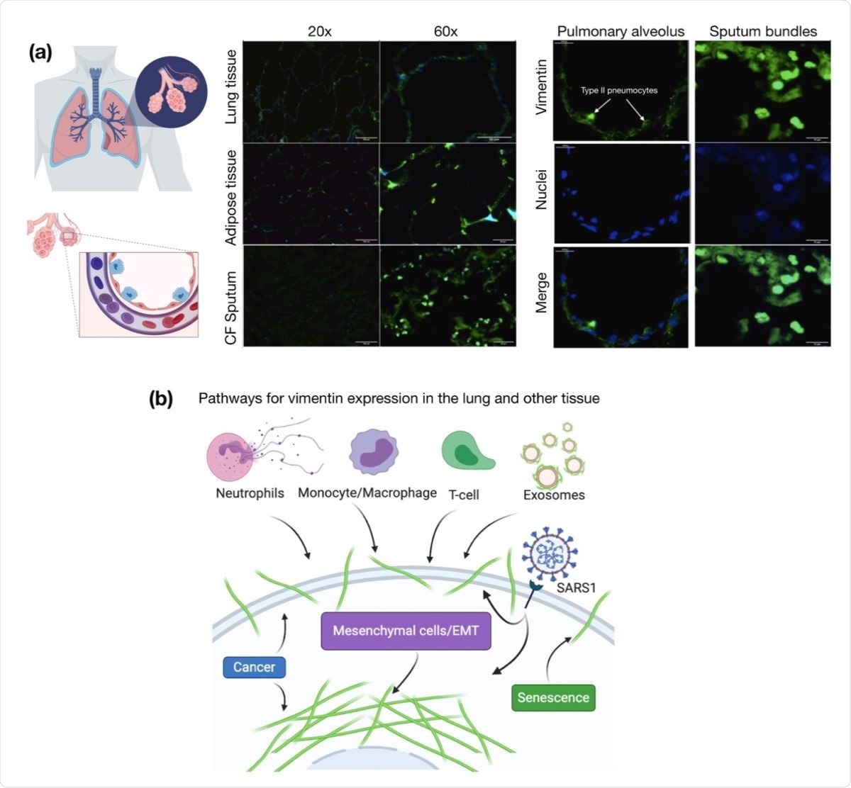 Presence of extracellular vimentin in human lung, airway fluids, and fat tissue. (a) Positive staining for extracellular vimentin (green) in human lung, fat tissue, and sputum obtained from cystic fibrosis (CF) patients. Vimentin appears on the apical side of type I and type II pneumocytes. DNA stained with DAPI. (b) There are numerous internal and exogenous pathways by which vimentin may be found in lung epithelia and other tissues, in either intracellular or cell surface forms (shown as green filaments). Vimentin is expressed directly by mesenchymal cells, cells having undergone EMT, cancer cells, senescent fibroblasts, and interestingly by cells bound and infected by the SARS virus (see Table 1). Exogenous sources of vimentin are largely related to immune response and tissue injury in the form of vimentin exported by neutrophils, Tlymphocytes, monocytes/macrophages, and exosomes. Schematics generated with Biorender.com.